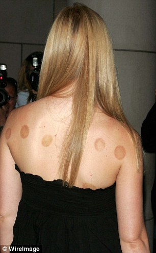 Gwyneth Paltrow is a fan of the detox properties of chinese cupping therapy.
